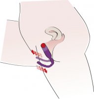 Vorschau: Schamlippenspreizer